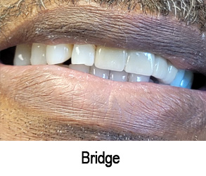 Smile Gallery - After