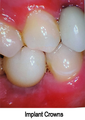 Smile Gallery - After